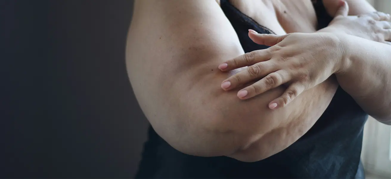 Lipödem: Warum die Krankheit oft fehldiagnostiziert wird